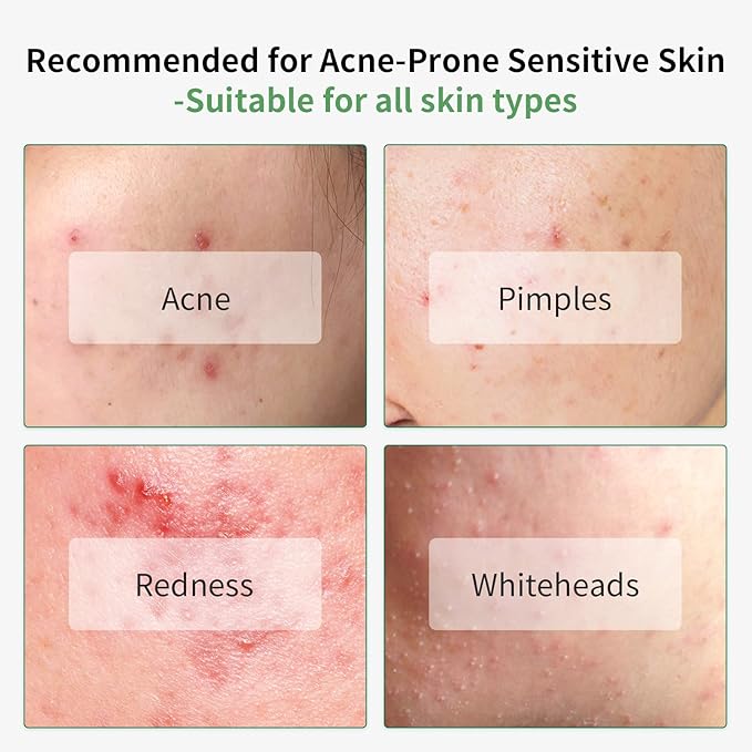 10% Salicylic Acid Serum, Acne Treatment for Face, 15ml/0.5oz, Minimize Pores, Active Skin Repair, Relieve Redness Blemish, Pimples Remover, Skin Barrier Repair for Acne Prone Sensitive Skin Care
