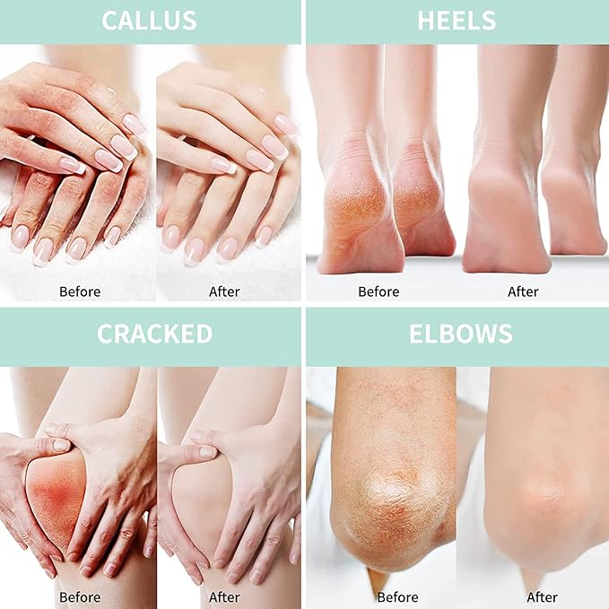 Urea Cream 20 Percent For Feet Plus 2% Salicylic Acid 8.82 oz || Foot Cream and Hand Cream Maximum Strength with Hyaluronic Acid, Tea Tree, and Aloe Vera for Deep Moisturizes, Callus Remover