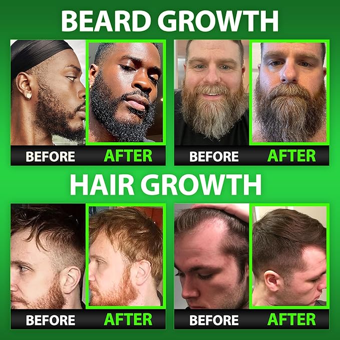 Beard Growth Kit w/Gummies Beard Growth Supplement & Hair Growth Vitamins for Men + Beard Roller Kit (2-pack: Hair Follicle Stimulator Beard Roller for Hair Growth Men Use as a Follicle Booster) USA