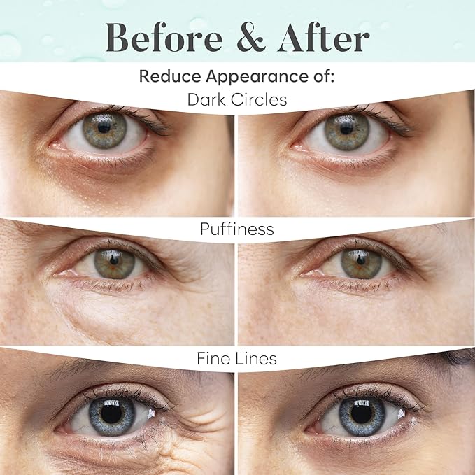 Aloe Vera Under Eye Patches (30 PAIRS), For Puffy Eyes and Dark Circles, Under Eye Mask with Hyaluronic Acid & Hydrolyzed Collagen, Deeply Hydrating Formula, Patch Yeux